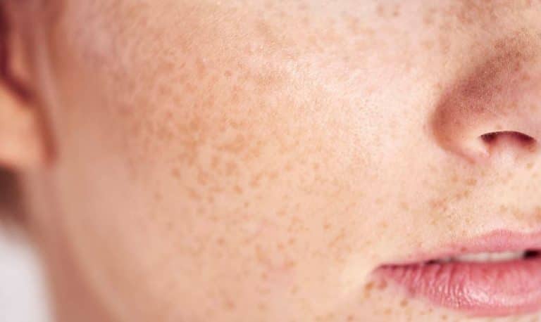 peau taches de rousseur pores dilat&eacute;s