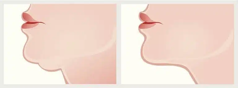 double menton