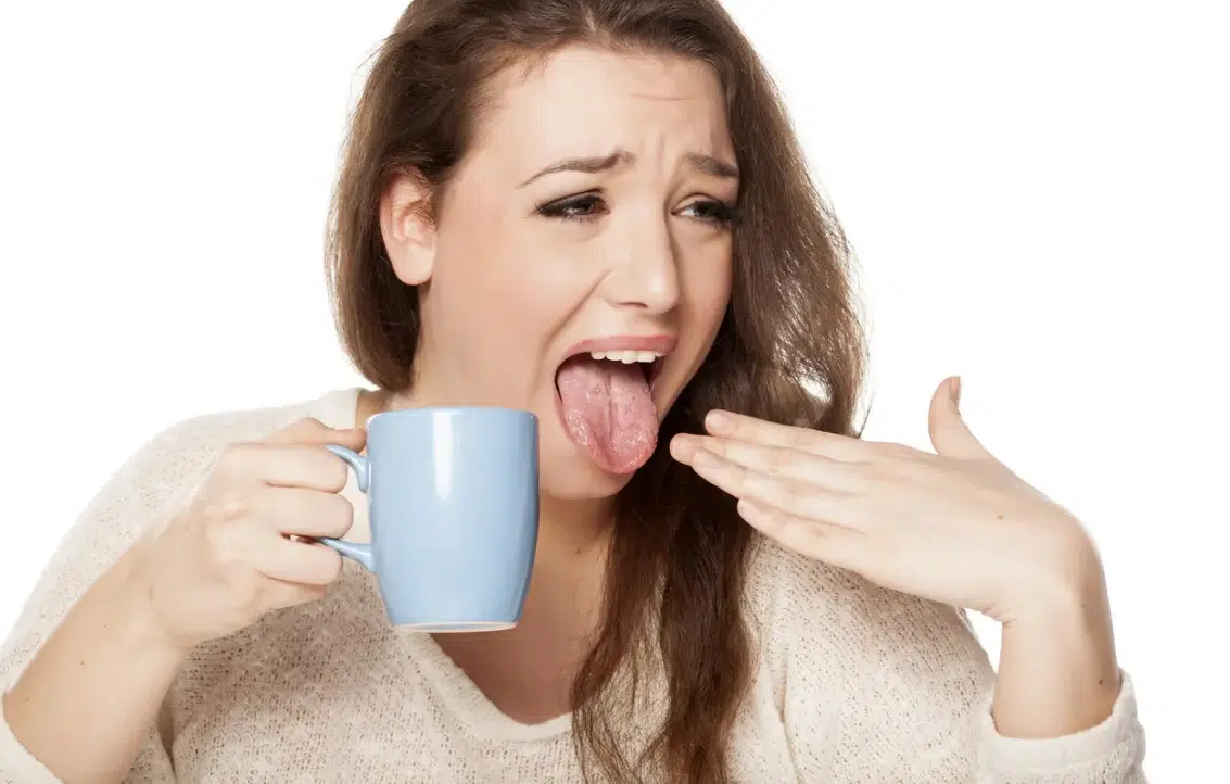 langue br&ucirc;l&eacute;e br&ucirc;lure de la langue