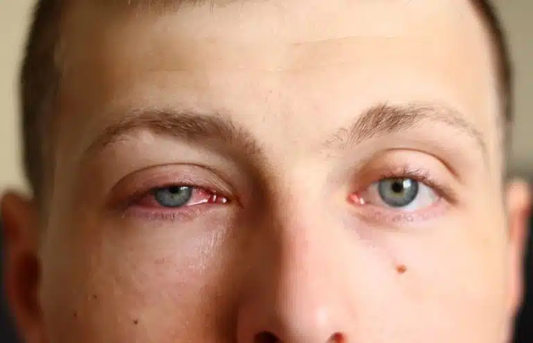 conjonctivite allergie yeux rouges