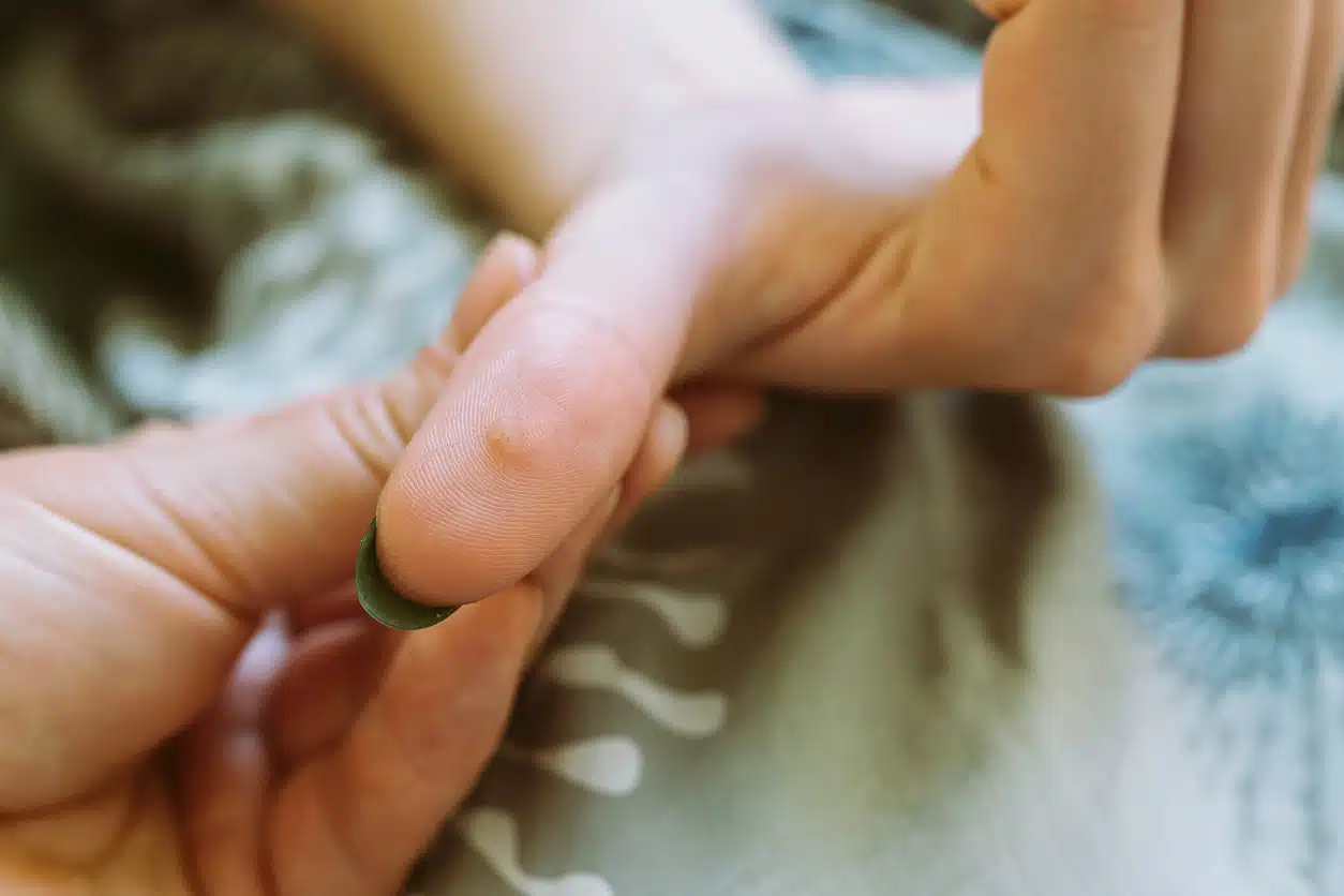 verrue &agrave; la main verrues au pouce rem&egrave;des naturels huiles essentielles plantes