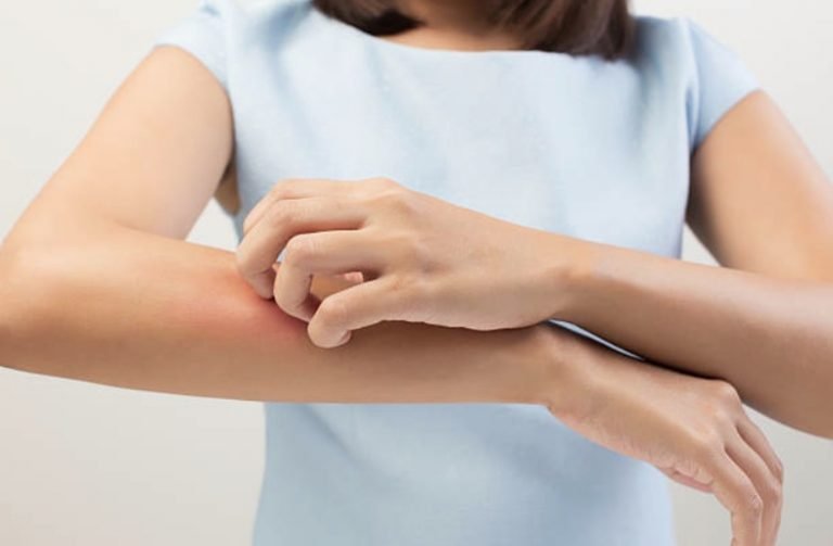 gratte d&eacute;mangeaisons eczema