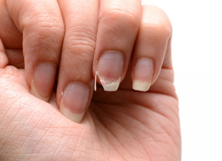 ongles cass&eacute;s ab&icirc;m&eacute;s