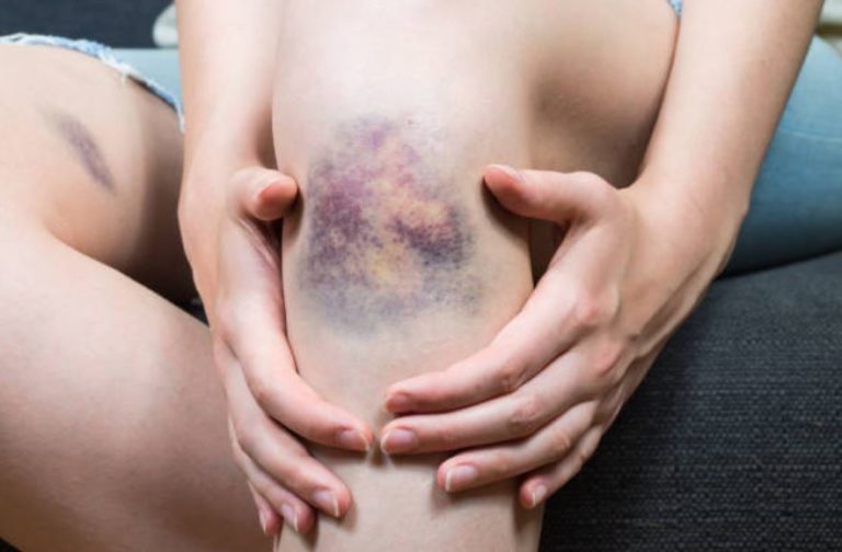 bleu contusion h&eacute;matome ecchymose choc coup