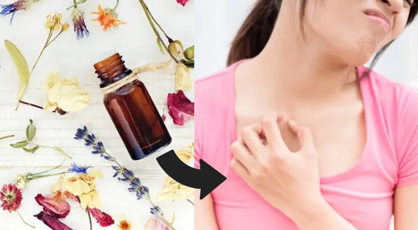 allergie r&eacute;action cutan&eacute;e d&eacute;mangeaison