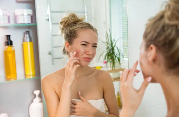 4 aliments qui peuvent donner des boutons si vous les consommez quotidiennement