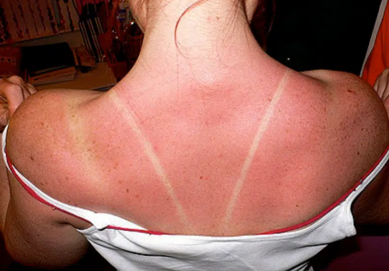 coup de soleil
