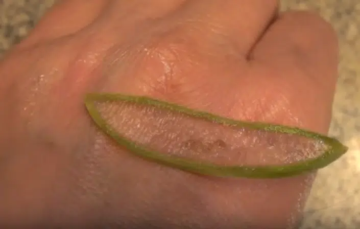 Appliquer de l'aloe vera sur une brûlure légère