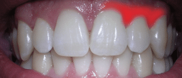 gencive irrit&eacute;e inflammation douleur gencives qui saignent dent