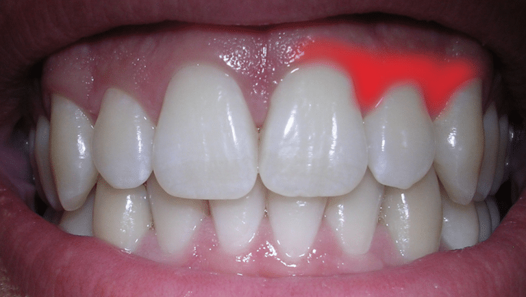 gencive irrit&eacute;e inflammation douleur gencives qui saignent dent