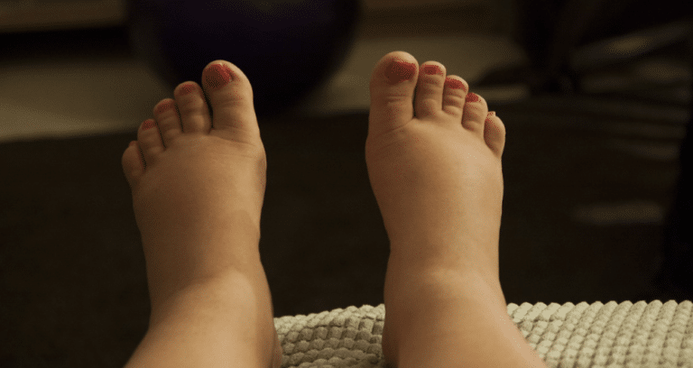 pieds gonfl&eacute;s enfl&eacute;s gonflements