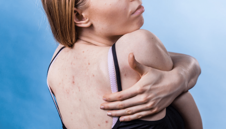 Boutons dans le dos : remède naturel et conseils pour vite les éradiquer