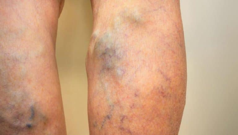 varices gonflement veines
