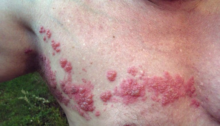 zona thorax