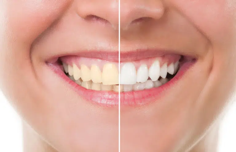 blanchiment dents plus blanches blanchir