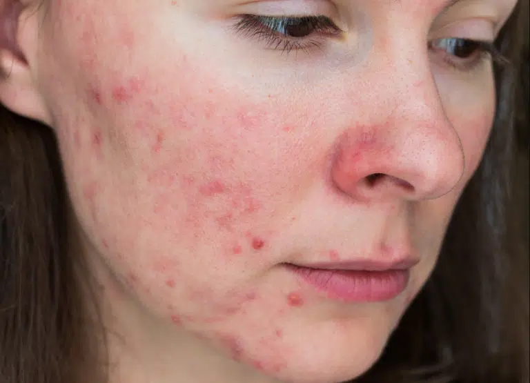 acn&eacute; boutons imperfections