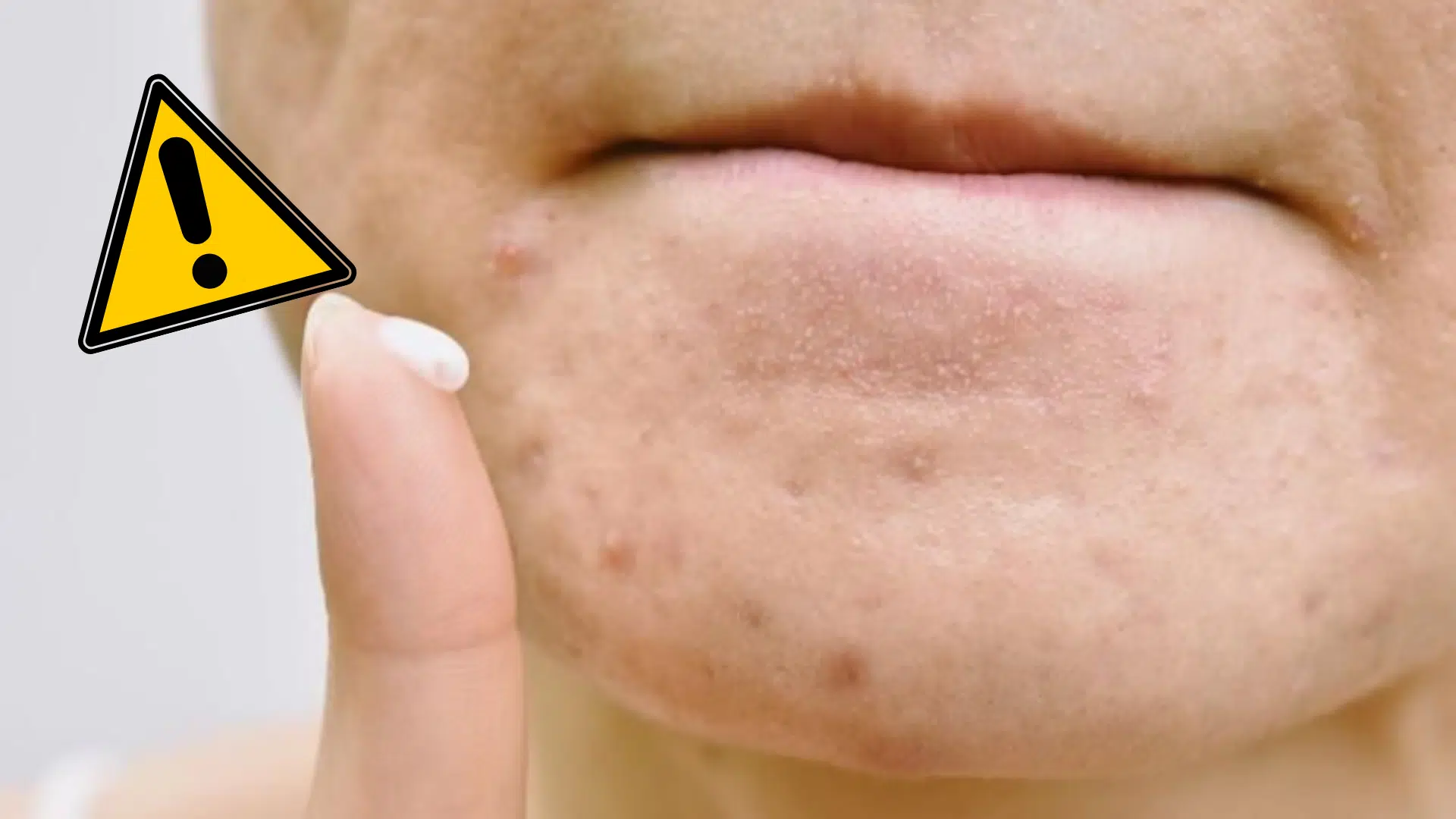 une dentifrice bouton ou br&ucirc;lure