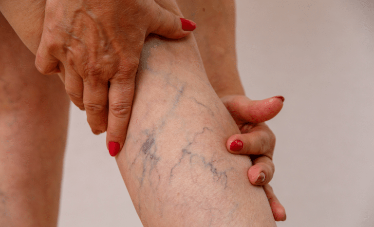 varices varicosit&eacute;s veines