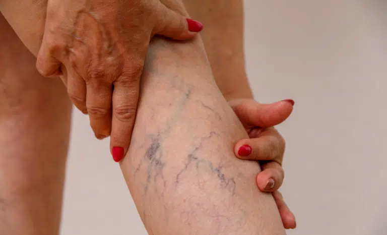 varices varicosit&eacute;s veines