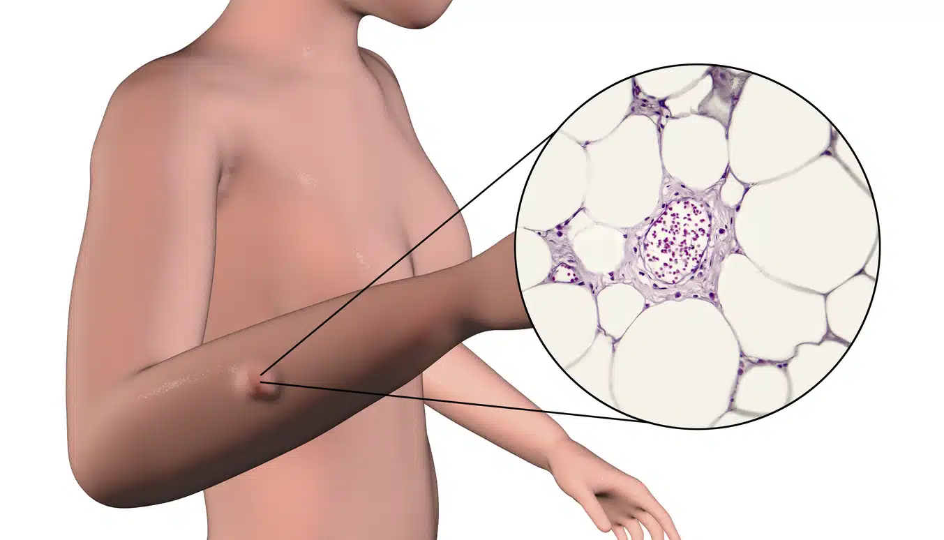 lipome