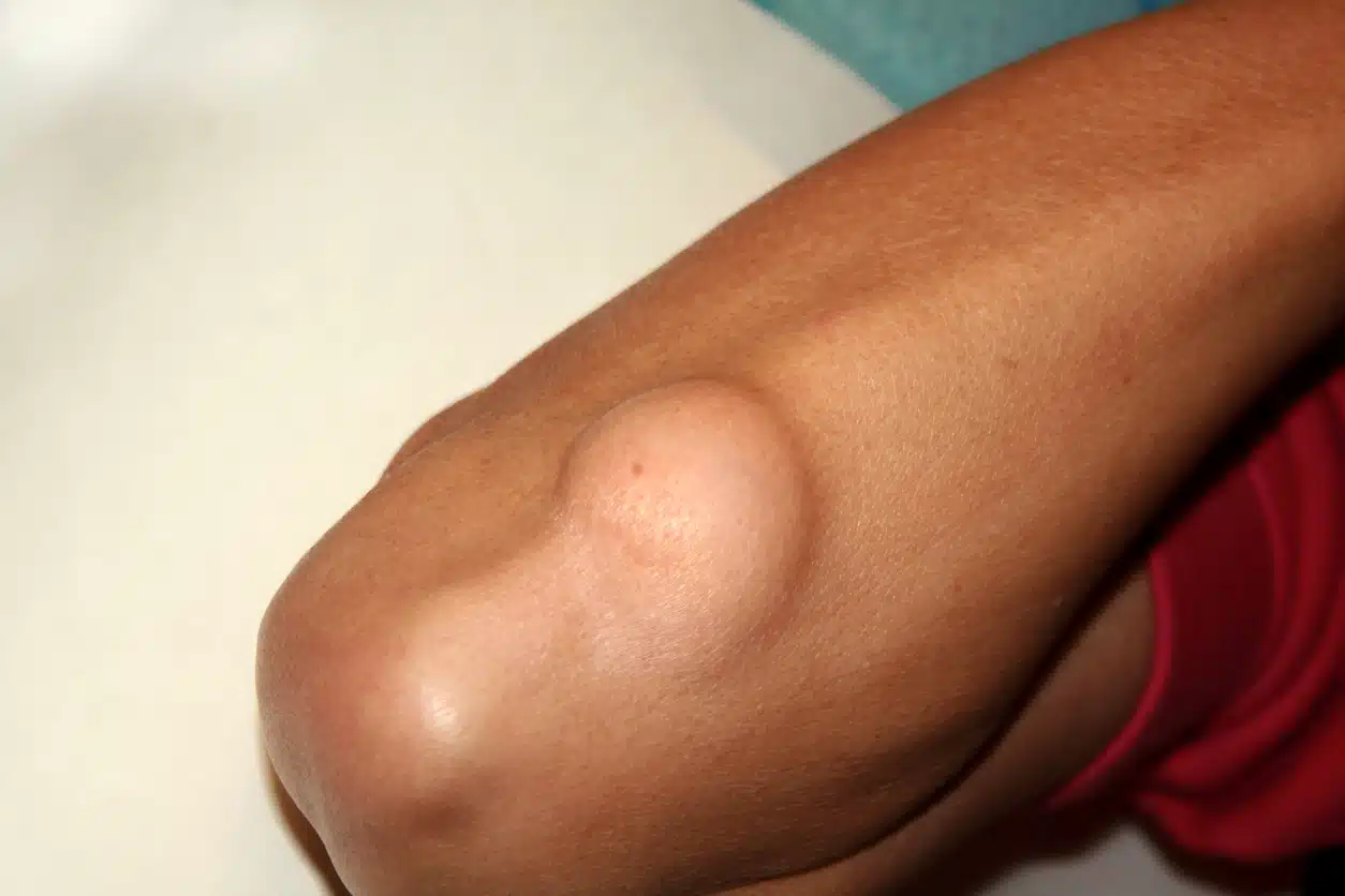 lipome avant bras