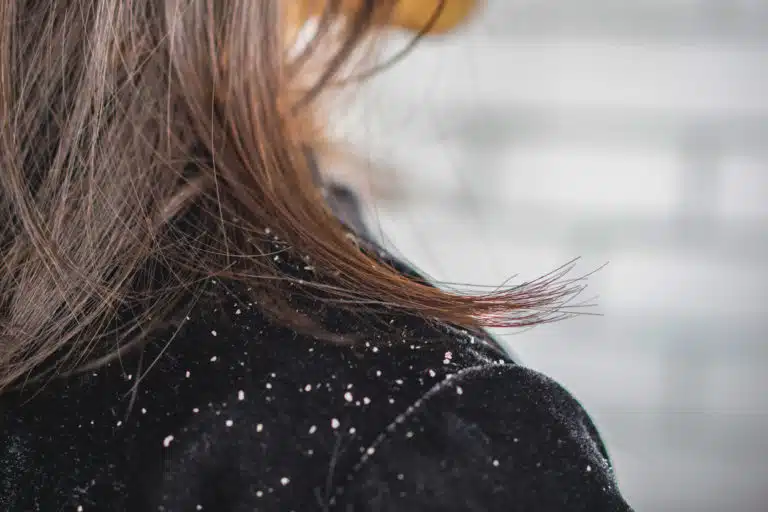 pellicules cheveux