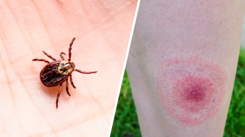 piq&ucirc;re de tique