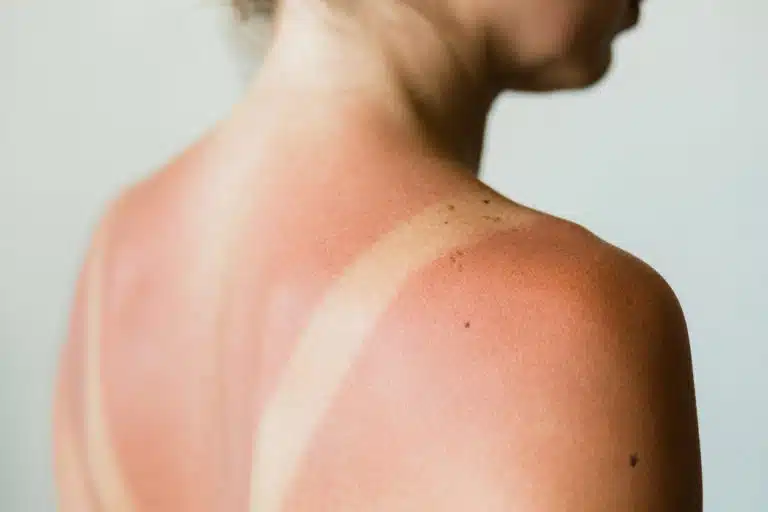 coup de soleil dos &eacute;paule