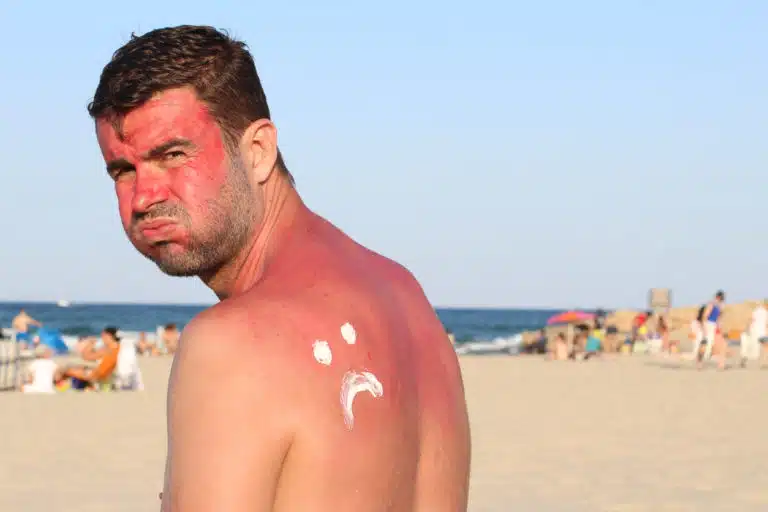 coup de soleil &eacute;t&eacute; plage