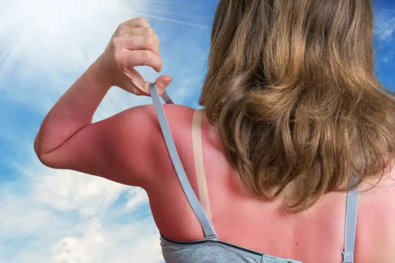 remèdes conseils coup de soleil