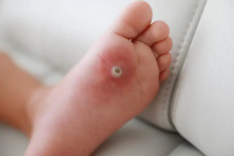 verrue plantaire verrue au pied