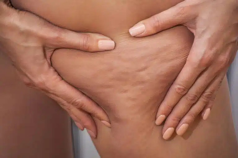 cellulite cuisse femme