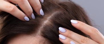 cuir chevelu cheveux pellicules perte de cheveux chute racines