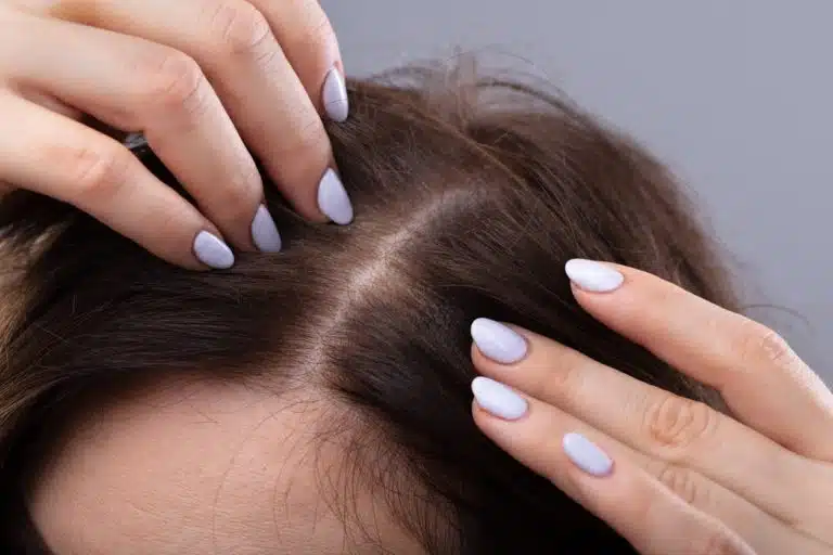 cuir chevelu cheveux pellicules perte de cheveux chute racines