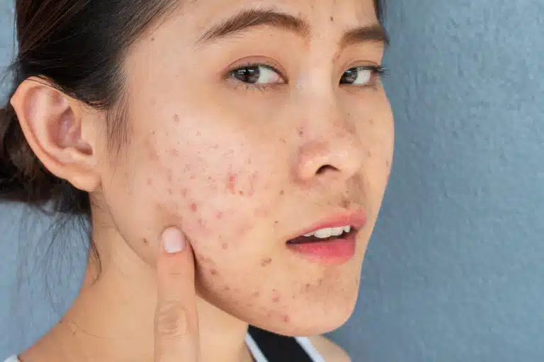 acn&eacute; boutons imperfections