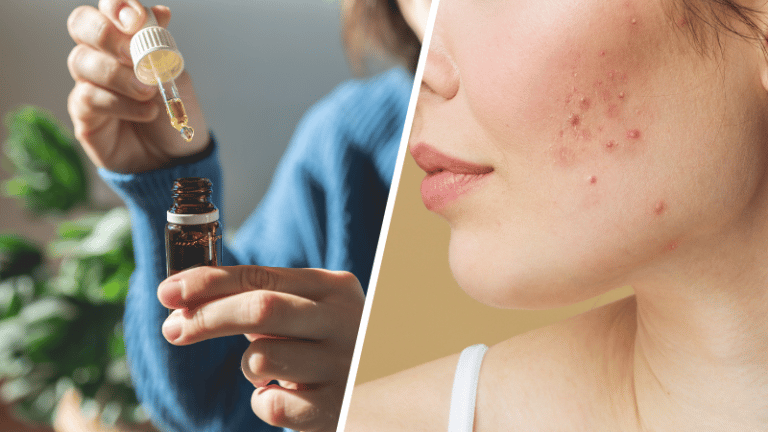 huile au CBD contre les boutons d'acn&eacute;