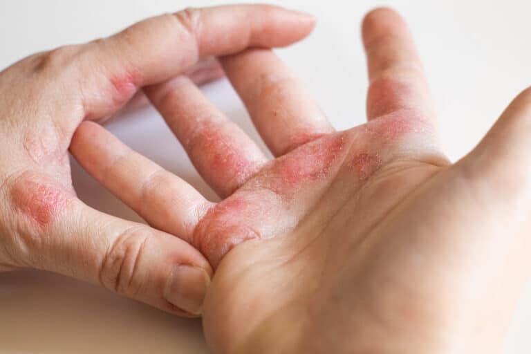 ecz&eacute;ma allergique