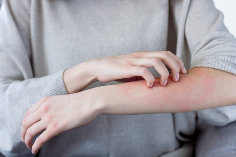 d&eacute;mangeaisons grattage ecz&eacute;ma allergie