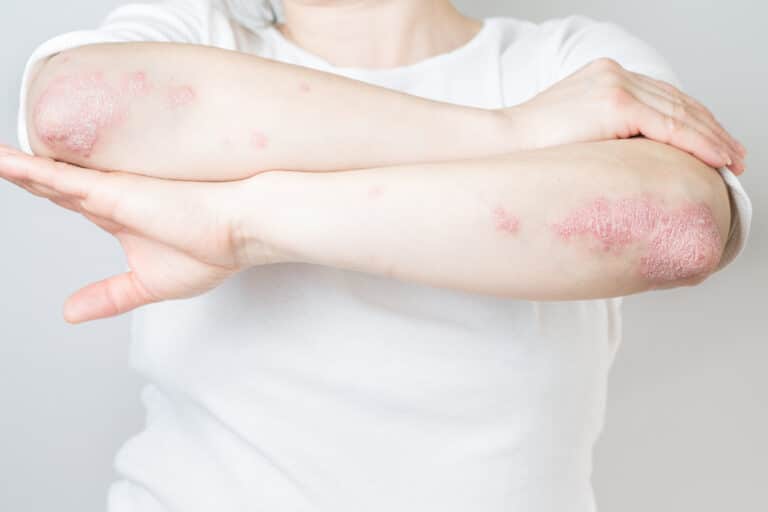 plaques pouss&eacute;e de psoriasis