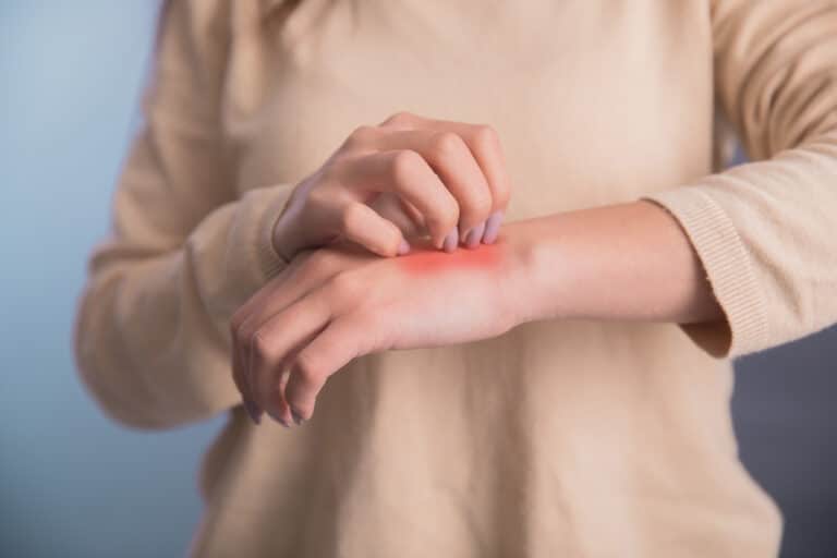 d&eacute;mangeaisons d&eacute;mangeaison grattage se gratter la peau de la main ecz&eacute;ma rougeur