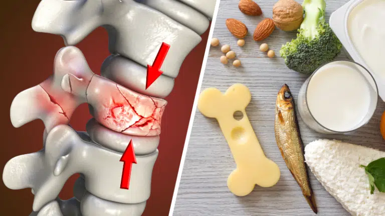 aliments contre l'ost&eacute;oporose sant&eacute; osseuse densit&eacute; osseuse fractures