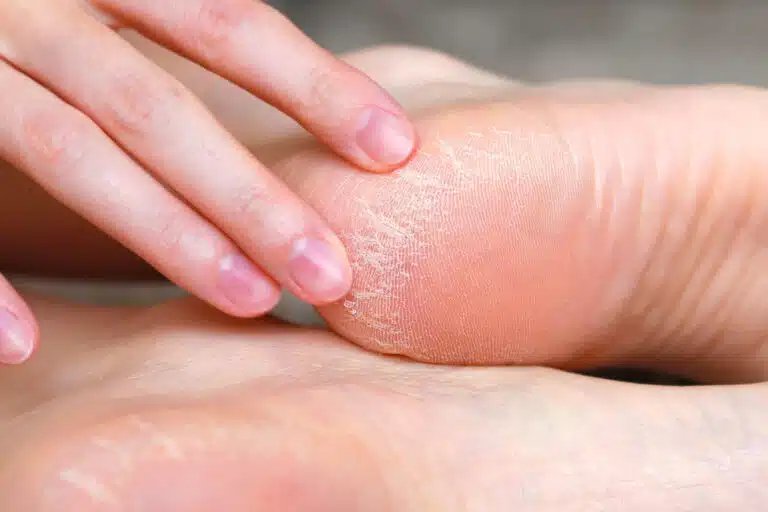 Peau s&egrave;che des talons avec des fissures sur les pieds