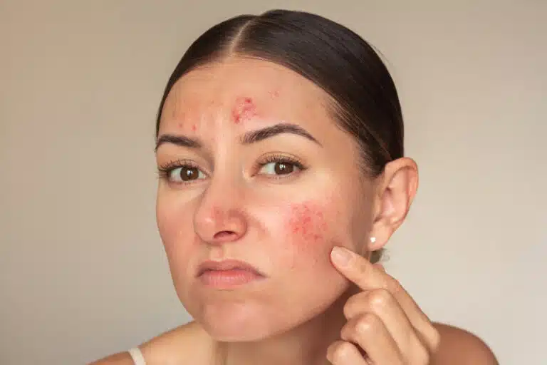 boutons acn&eacute; rosac&eacute;e imperfections visage