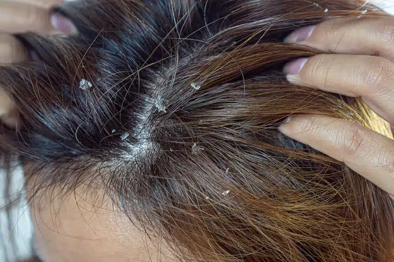 cuir chevelu de pellicules, dermatite, dermite s&eacute;borrh&eacute;ique, plaques de squames