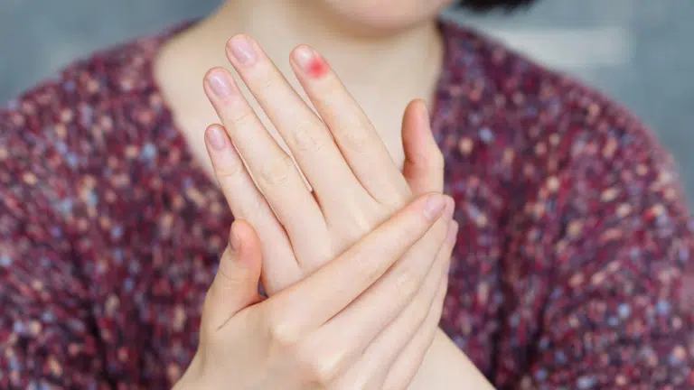 panaris douleur irritation sur le bord de l'ongle paronychie