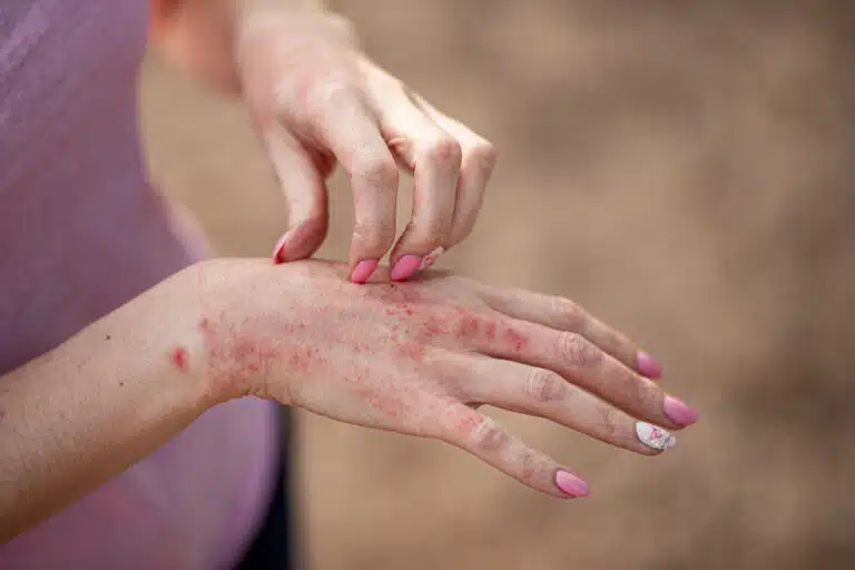 Dermatite ecz&eacute;ma sur les mains taches rouges sur la peau peau s&egrave;che