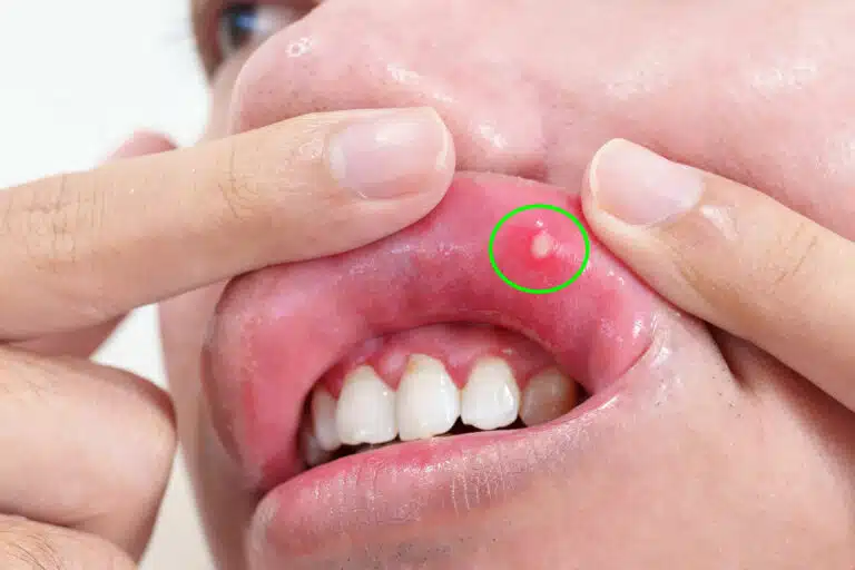 Ulc&egrave;re buccal douloureux ou stomatite aphteuse aphte