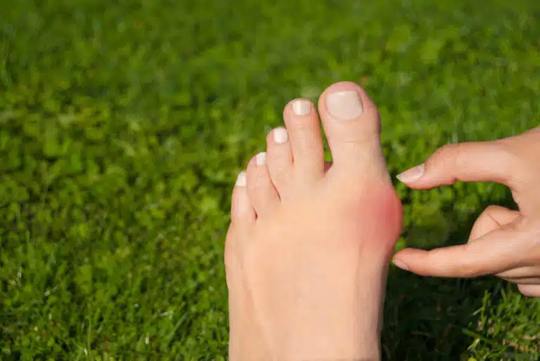 vue sur oignon (Hallux valgus) douleurs orteils et pieds
