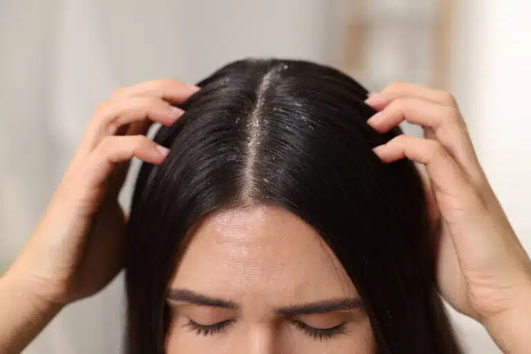 pellicules persistantes cheveux