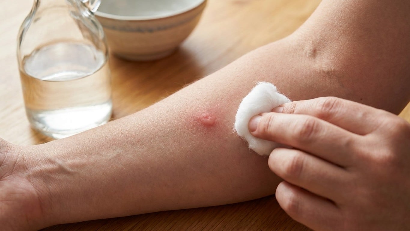 Fini la piq&ucirc;re de gu&ecirc;pe qui gonfle pendant tout le repas : ce que les anciens tamponnaient dessus neutralise le venin en q...